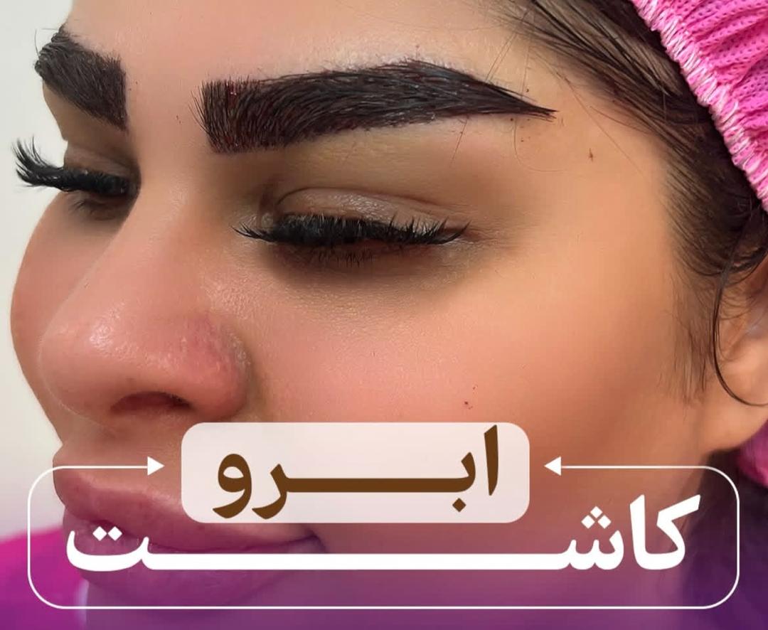 کاشت ابرو